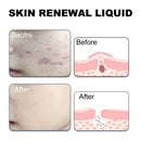 West Month Skin Renewal Liquid  Reduce Acne Print Repair Acne Muscle Mild Clear Acne Hydrating Essence