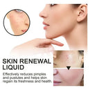 West Month Skin Renewal Liquid  Reduce Acne Print Repair Acne Muscle Mild Clear Acne Hydrating Essence